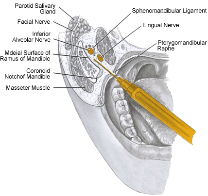 Dental Malpractice Central  Inferior Alveolar Nerve Anatomy